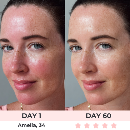 DermaBeam™ - LED Face Mask
